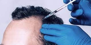 Hair filler injection