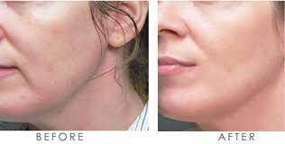 1ml Stylage filler and 20 units Allergan Botox