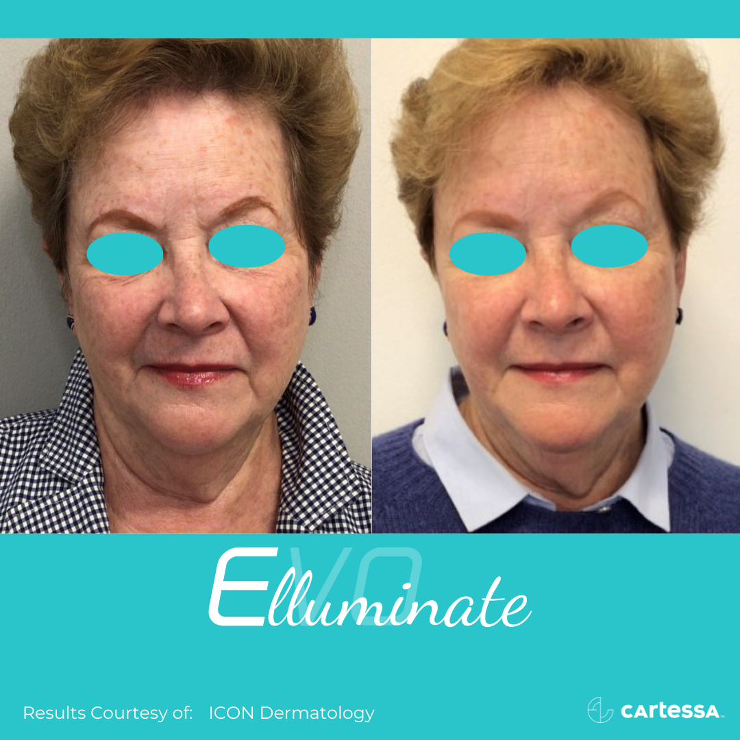 EVO Elluminate treatment(2sessions)