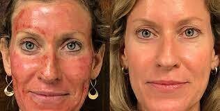 PRP Vampire facial special