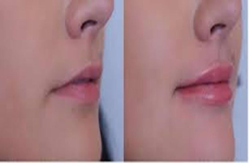 Lip Fille Linear Threading Technique