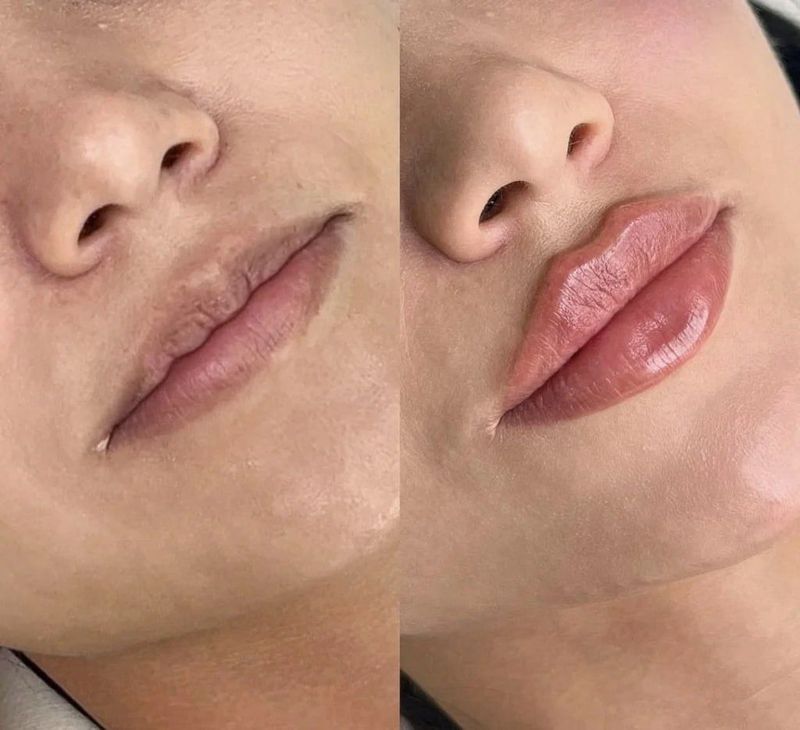 Russian volume lip filler