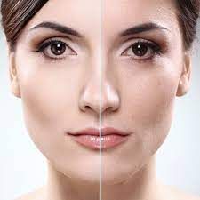 IPL Treatments