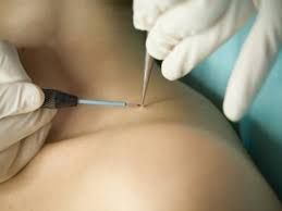 Skin Tag, Milia & Cherry Spot Removal