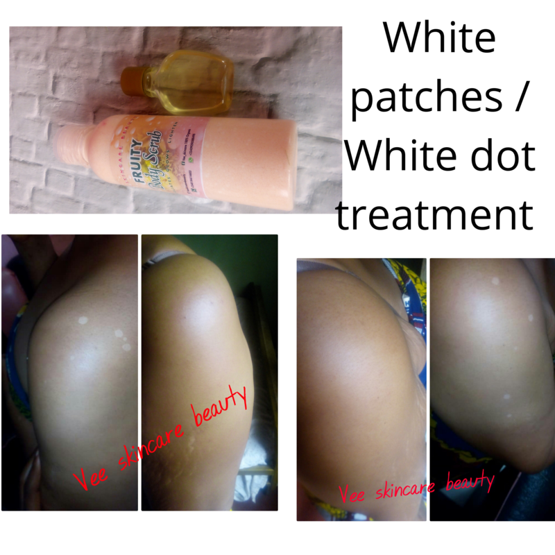 White patches and white dots treatment