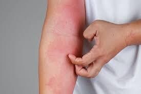 Eczema Prone Skin