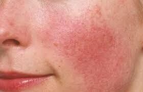 Rosacea Prone Skin