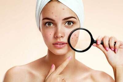Natural Skincare for Acne Prone Skin