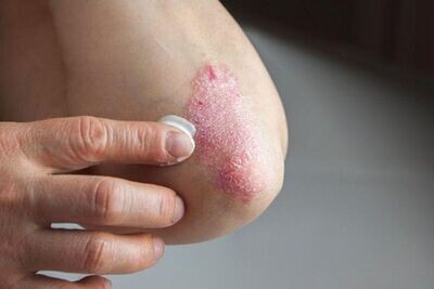 Natural Skincare for Psoriasis Prone Skin