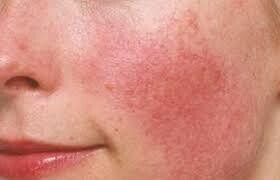 Natural Skincare for Rosacea Prone Skin