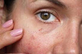Natural Skincare for Sensitive Skin