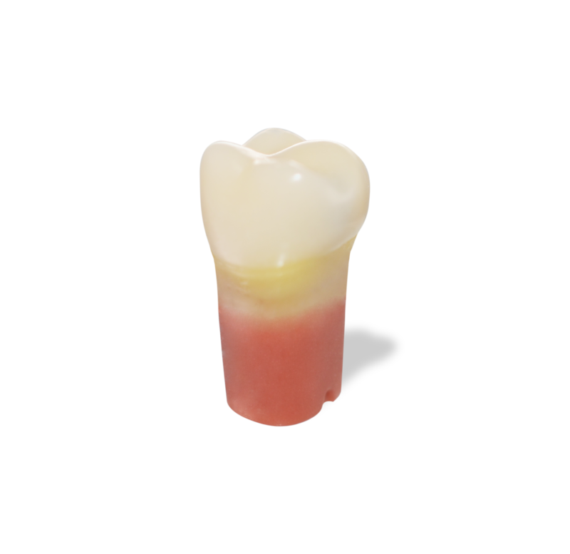 RTX Caries Teeth Mesial #14