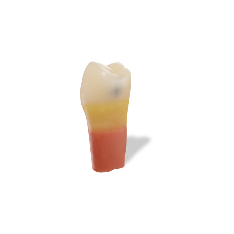 RTX Caries Teeth Distal #20