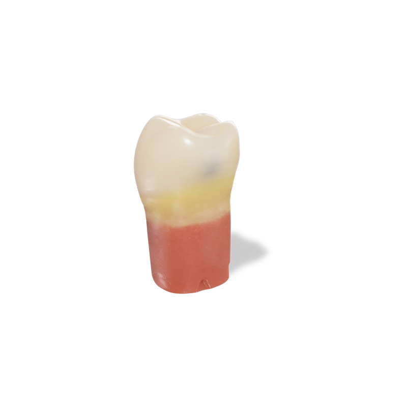 RTX Caries Teeth Mesial #30