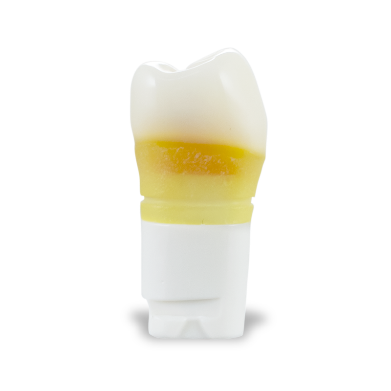 DTX Carious Tooth #20
