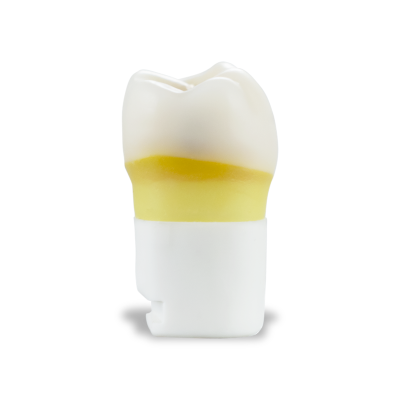 DTX Carious Tooth #30