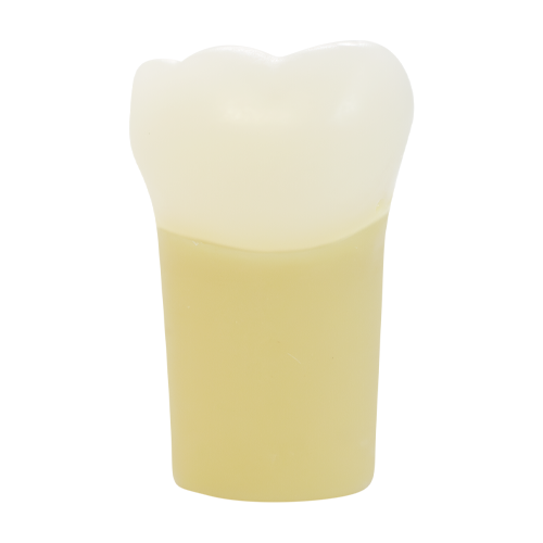 PCT Caries, Mesial Occlusal (Class II) #30