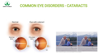 Products for treating cataracts,  Glaucoma, Diabetic retinipathy