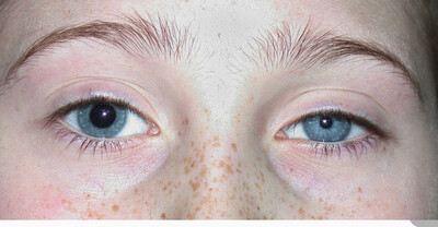 Eye care 