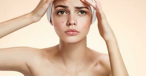 Tractament depuratiu per combatre l'ACNE