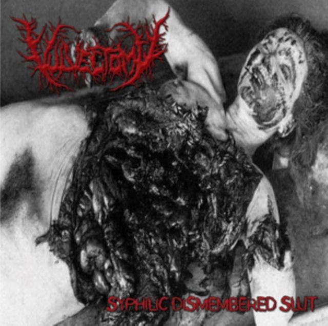 Vulvectomy