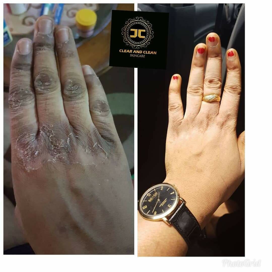 clear and clean knuckle cream