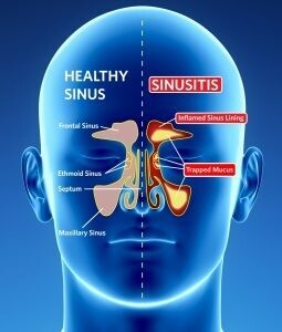 Za sinus (за синусит, гайморит)