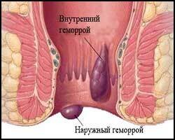 Hemoroidi (Геморрой)