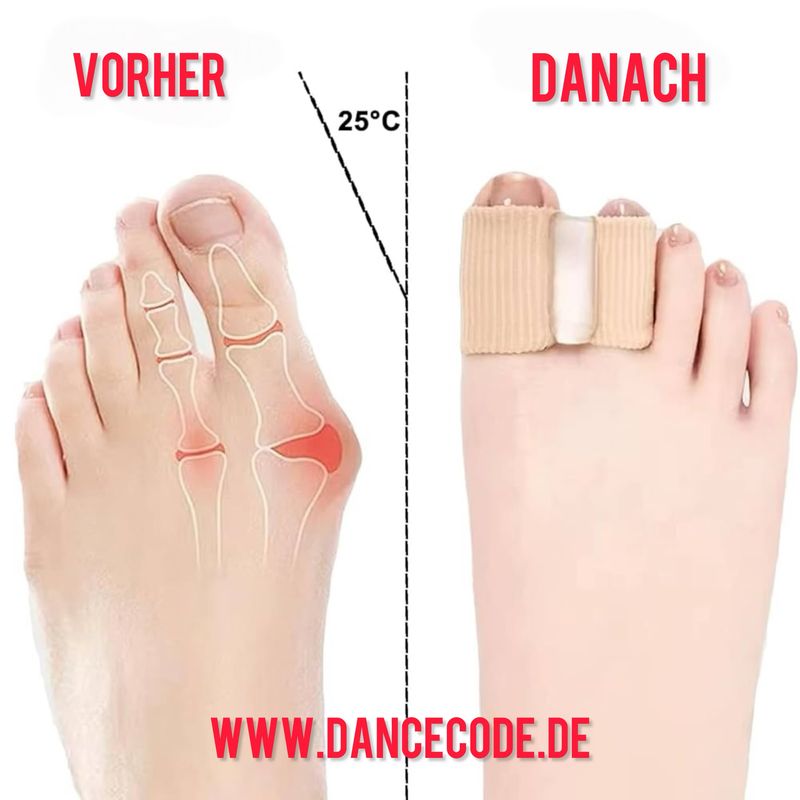 Hallux Valgus Korrektur , Zehenspreizer für Hallux Valgus Dancecode