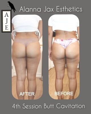 6 SESSIONS CAVITATION BUTT LIFT - CALL FOR FREE CONSULTATION