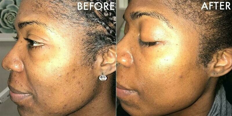 Before and After