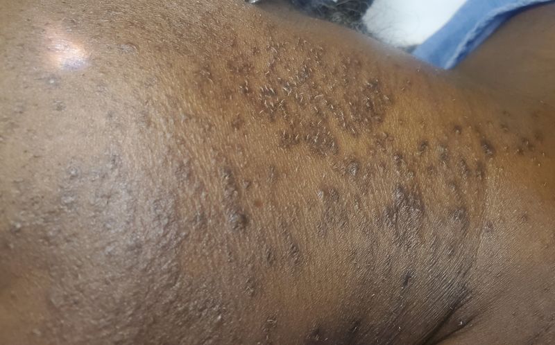 Laser Hair Removal — Full Face &amp; Beard Area (Black Skin)