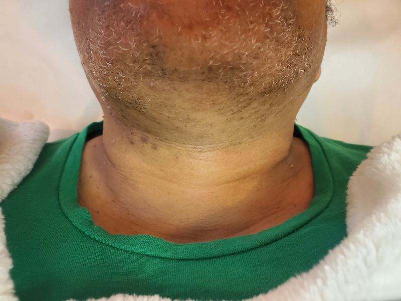 Laser Hair Removal — PCOS Jawline Hair (Black Skin)no pricing only sku and weight