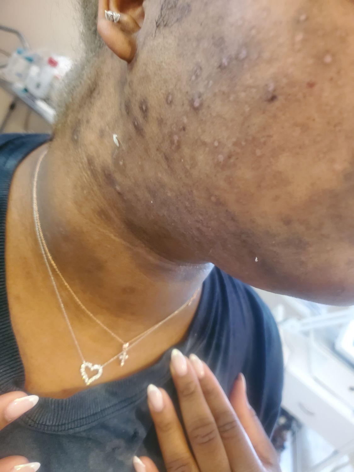 Laser Hair Removal — Neck Ingrowns &amp; Razor Bumps (Black Skin)