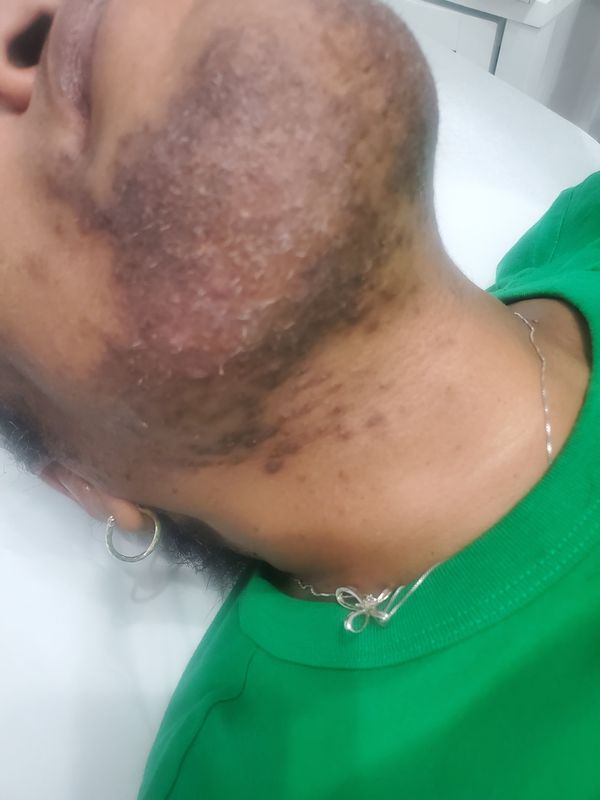 Dark Spots from Ingrowns — Black &amp; Dark Skin