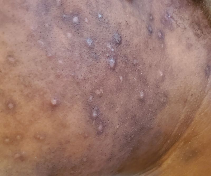 Crystal Microdermabrasion + Mandelic Acid (Black &amp; Dark Skin)