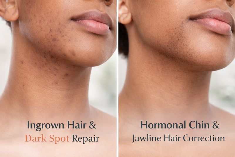 Hormonal Chin &amp; Jawline Hair Correction (Laser Treatment)