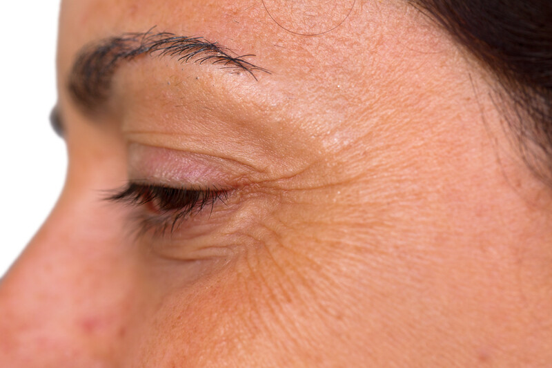 Crow&#39;s feet removal (Botox)