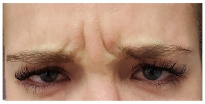 Frown Line ('Elevens') smoothing (Botox)
