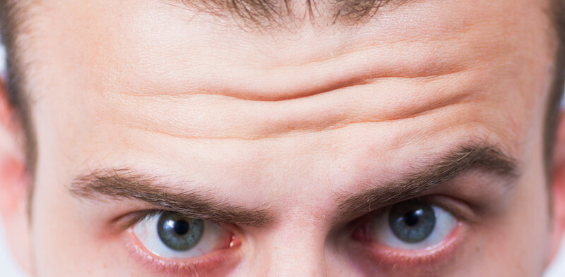 &#39;Thinking Lines&#39; forehead wrinkle removal (botox)