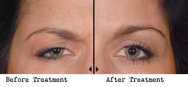 Non invasive Browlift (Botox)