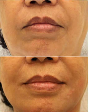 Sagging mouth corners - &#39;Sad Lips&#39; (Botox)