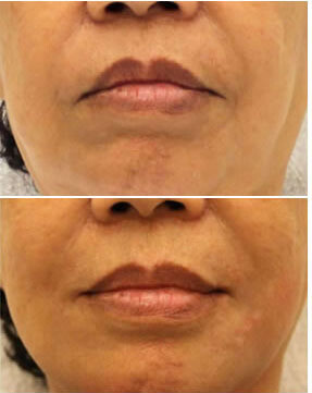 Sagging mouth corners - 'Sad Lips' (Botox)