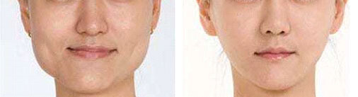 Jaw botox