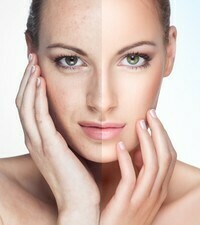 Infusion Peel Microdermabrasion + Infusion Infusion Peel Microdermabrasion + Infusion