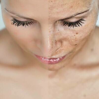 IPL Photo Facial - Remove Dark Spots IPL Photo Facial - Remove Dark Spots