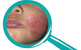 Problemas de piel, dermatológicos graves