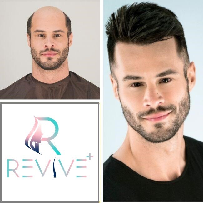 Non-Surgical Hair Replacement Services