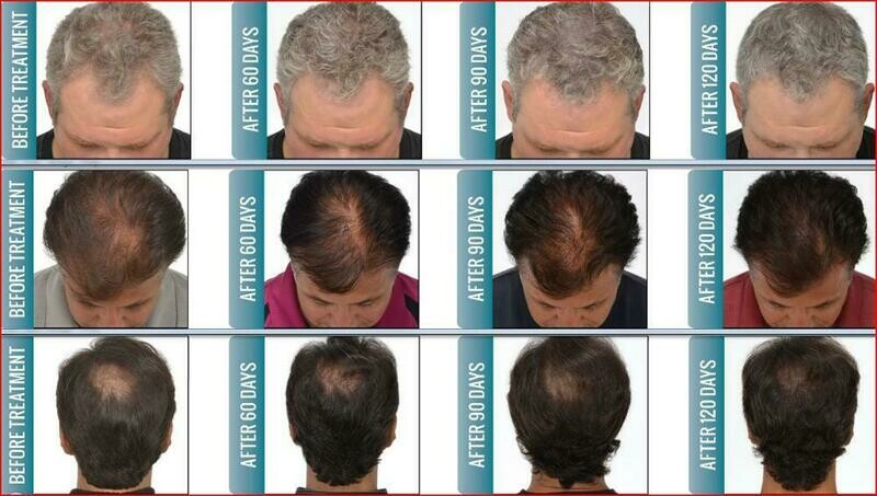 HAIR GROWTH LOW LEVEL LASER TREATMENT (COLD LASER)