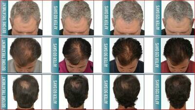 HAIR GROWTH LOW LEVEL LASER TREATMENT (COLD LASER)